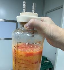 舞钢水动力吸脂手术要做多久？